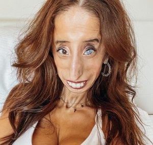 Lizzie Velasquez