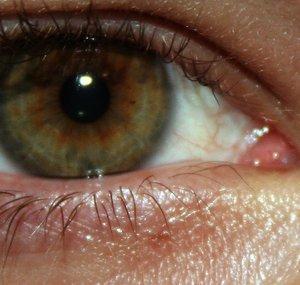 Exturnal Remedies