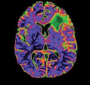 UCSF Neurosurgery